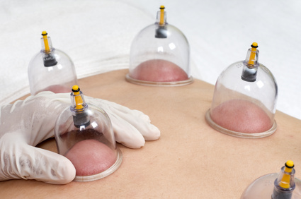 Cupping