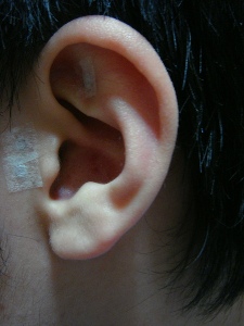 earacupuncturesmall